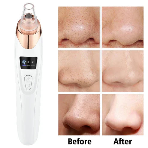 USB-rechargeable skin vacuum for clear pores.
